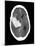 Subarachnoid Haemorrhage, MRI Scan-Du Cane Medical-Mounted Photographic Print