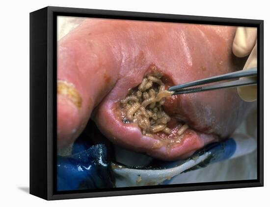 Surgeon Placing Maggots In a Wound To Clean It-Volker Steger-Framed Premier Image Canvas