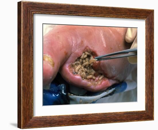 Surgeon Placing Maggots In a Wound To Clean It-Volker Steger-Framed Photographic Print