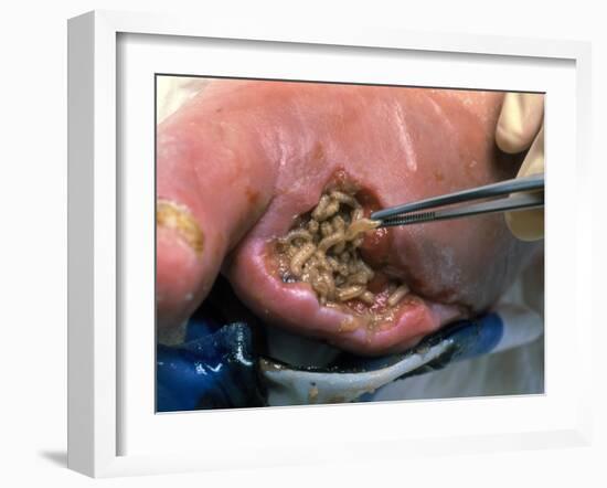 Surgeon Placing Maggots In a Wound To Clean It-Volker Steger-Framed Photographic Print