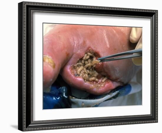 Surgeon Placing Maggots In a Wound To Clean It-Volker Steger-Framed Photographic Print