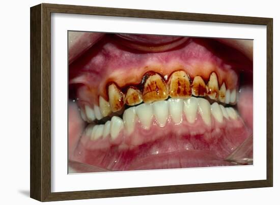 Teeth Showing Plaque-Science Photo Library-Framed Photographic Print