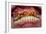 Teeth Showing Plaque-Science Photo Library-Framed Photographic Print