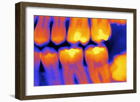 Teeth with Fillings, X-ray-PASIEKA-Framed Photographic Print