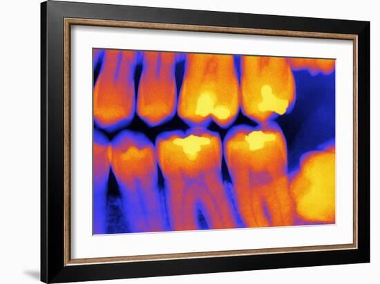 Teeth with Fillings, X-ray-PASIEKA-Framed Photographic Print