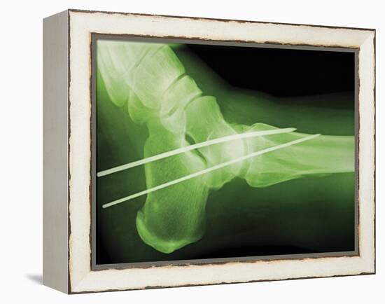 Temporary Ankle Immobilisation, X-ray-Miriam Maslo-Framed Premier Image Canvas