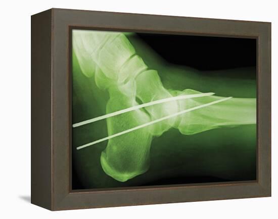 Temporary Ankle Immobilisation, X-ray-Miriam Maslo-Framed Premier Image Canvas