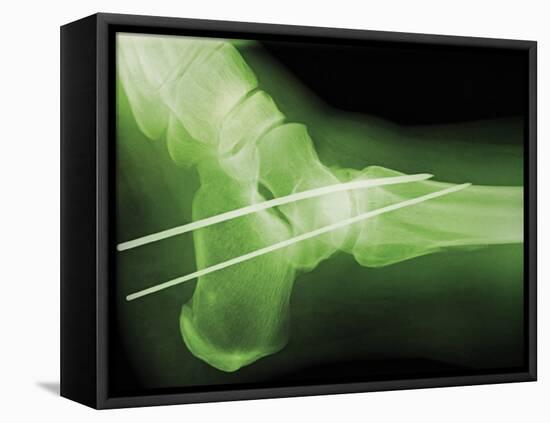 Temporary Ankle Immobilisation, X-ray-Miriam Maslo-Framed Premier Image Canvas