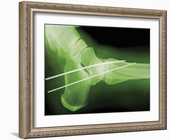 Temporary Ankle Immobilisation, X-ray-Miriam Maslo-Framed Photographic Print