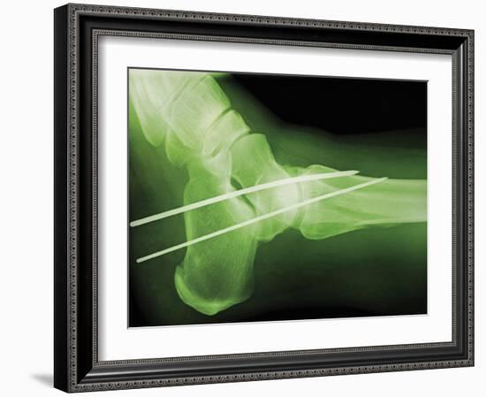 Temporary Ankle Immobilisation, X-ray-Miriam Maslo-Framed Photographic Print