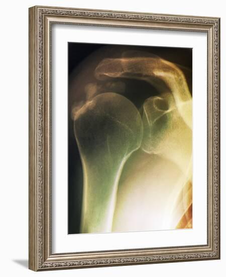 Tendinitis of the Shoulder, X-ray-ZEPHYR-Framed Photographic Print