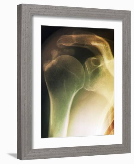 Tendinitis of the Shoulder, X-ray-ZEPHYR-Framed Photographic Print