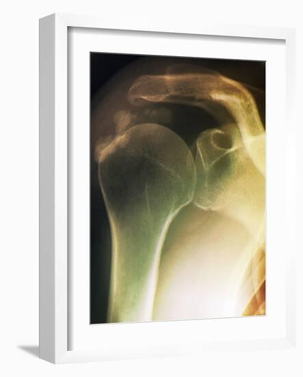 Tendinitis of the Shoulder, X-ray-ZEPHYR-Framed Photographic Print