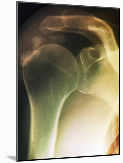 Tendinitis of the Shoulder, X-ray-ZEPHYR-Mounted Photographic Print