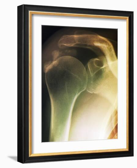 Tendinitis of the Shoulder, X-ray-ZEPHYR-Framed Photographic Print