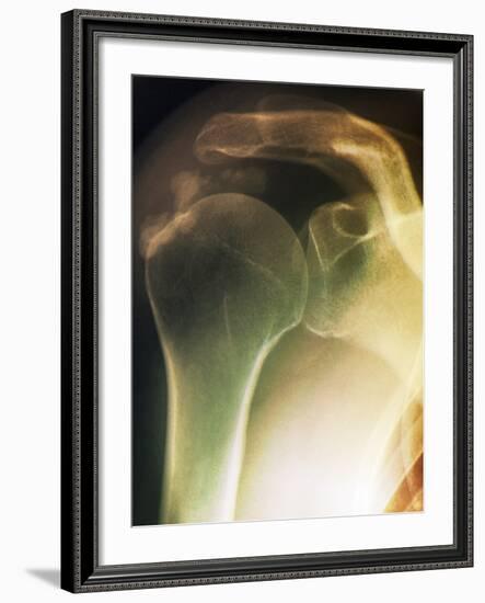 Tendinitis of the Shoulder, X-ray-ZEPHYR-Framed Photographic Print