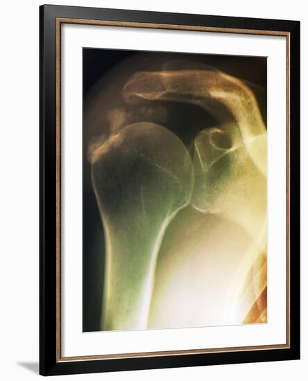 Tendinitis of the Shoulder, X-ray-ZEPHYR-Framed Photographic Print