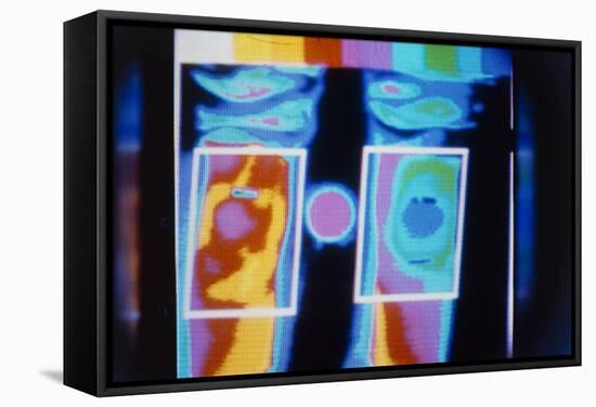 Thermogram Comparing a Normal And Arthritic Knee-Science Photo Library-Framed Premier Image Canvas