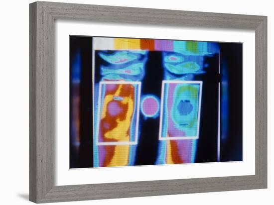 Thermogram Comparing a Normal And Arthritic Knee-Science Photo Library-Framed Photographic Print