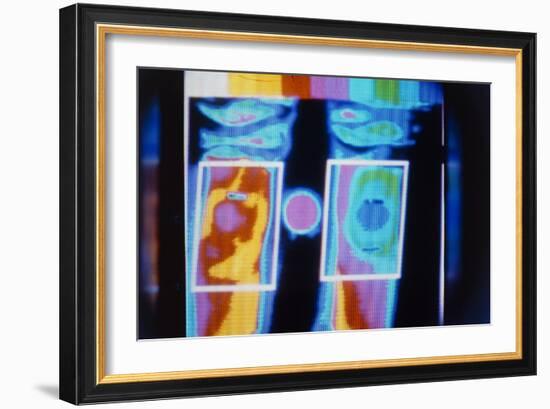 Thermogram Comparing a Normal And Arthritic Knee-Science Photo Library-Framed Photographic Print