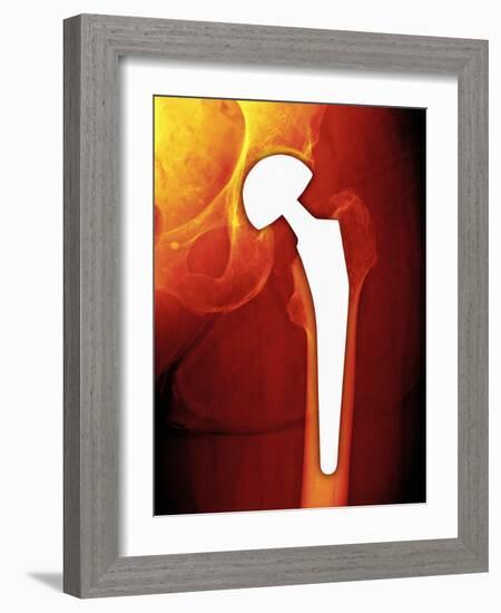 Total Hip Replacement, X-ray-Miriam Maslo-Framed Photographic Print