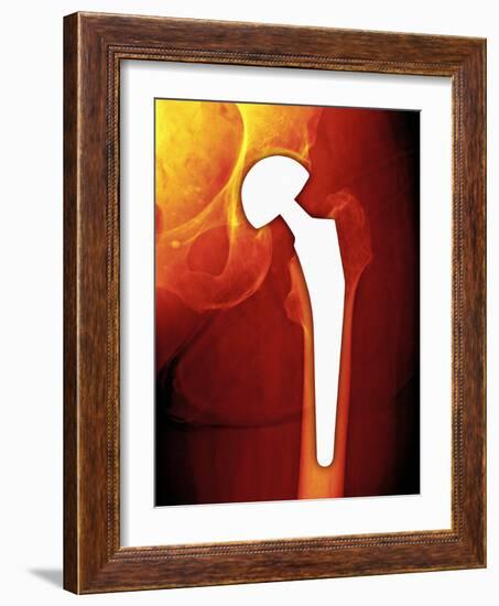 Total Hip Replacement, X-ray-Miriam Maslo-Framed Photographic Print