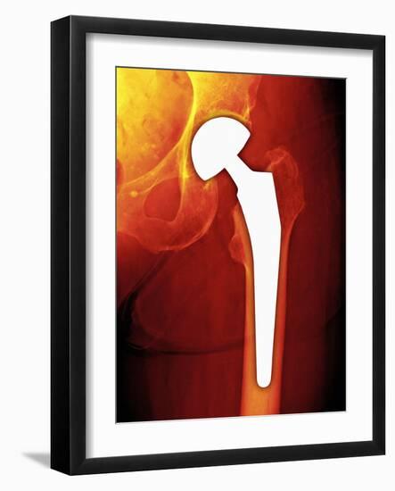 Total Hip Replacement, X-ray-Miriam Maslo-Framed Photographic Print