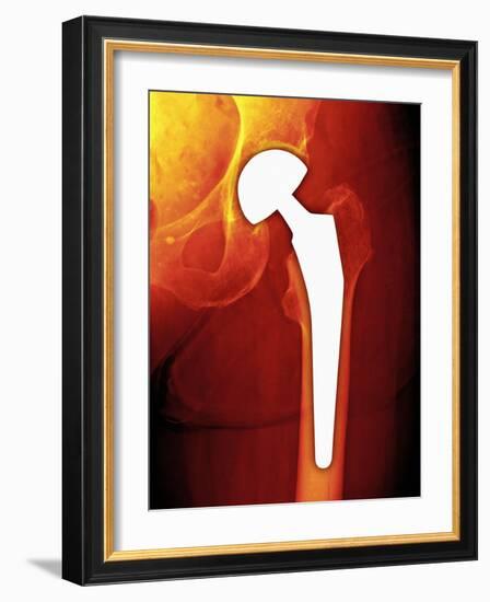 Total Hip Replacement, X-ray-Miriam Maslo-Framed Photographic Print