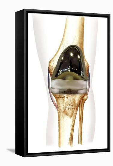 Total Knee Replacement, Artwork-null-Framed Premier Image Canvas