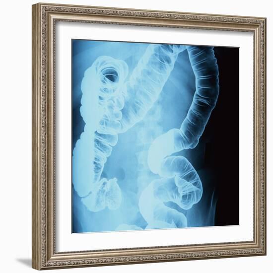 X-Ray of Intestines-Robert Llewellyn-Framed Photographic Print