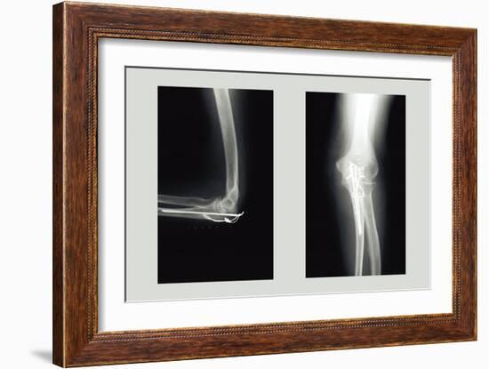 Shattered Elbow Repair-null-Framed Art Print