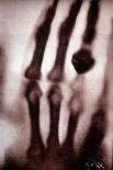 Roentgen Rays (Rontgen) or X-Rays First Photograph: the Hand of Roentgen's Wife. 22/12/1895.-Unknown Artist-Giclee Print