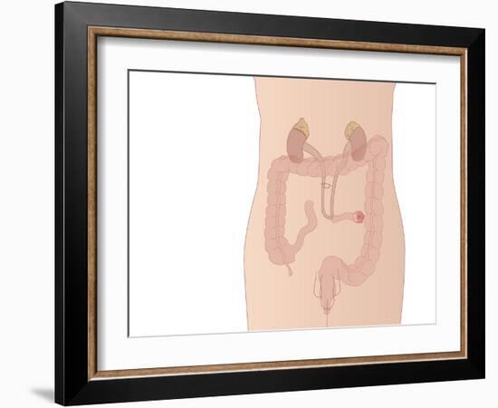 Urostomy Procedure, Artwork-Peter Gardiner-Framed Photographic Print