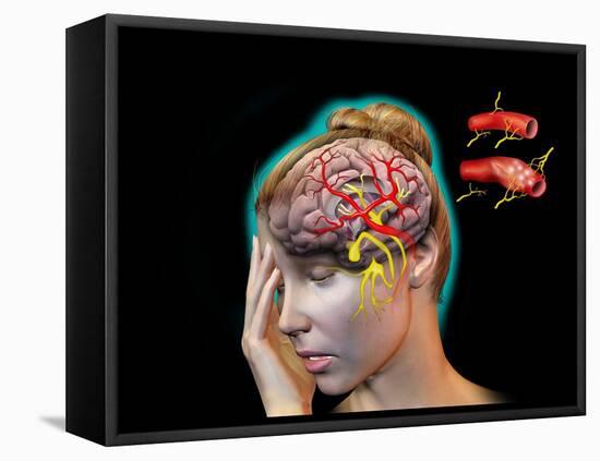 Vascular Causes of Headaches-Jose Antonio-Framed Premier Image Canvas