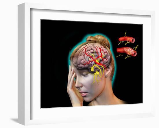 Vascular Causes of Headaches-Jose Antonio-Framed Photographic Print