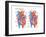 Ventricular Septal Defect-Encyclopaedia Britannica-Framed Art Print