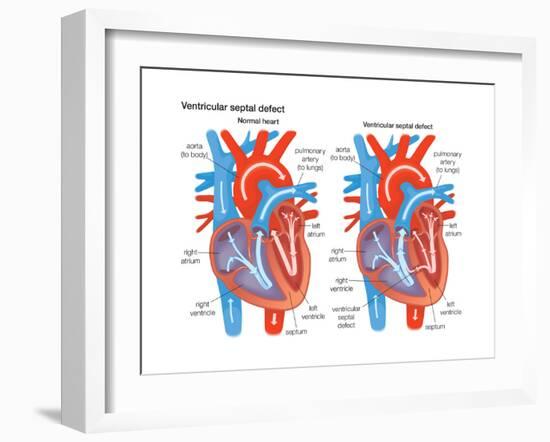 Ventricular Septal Defect-Encyclopaedia Britannica-Framed Art Print