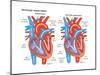 Ventricular Septal Defect-Encyclopaedia Britannica-Mounted Art Print