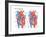 Ventricular Septal Defect-Encyclopaedia Britannica-Framed Art Print