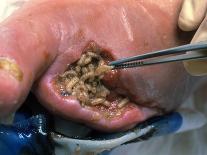 Maggots (Lucilia Sericata) Cleaning a Wound-Volker Steger-Photographic Print
