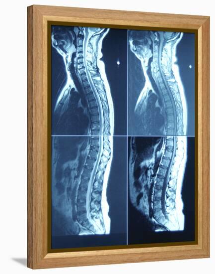 X-Ray Image of Person's Spine on Computer Screen-null-Framed Premier Image Canvas