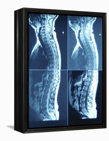 X-Ray Image of Person's Spine on Computer Screen-null-Framed Premier Image Canvas