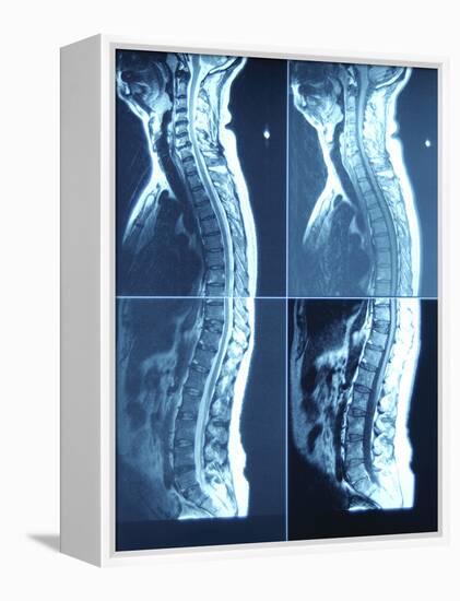 X-Ray Image of Person's Spine on Computer Screen-null-Framed Premier Image Canvas