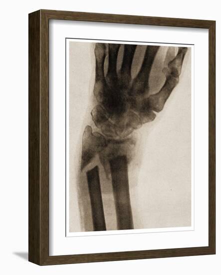 X Ray of a Fractured Wrist C.1890-German School-Framed Giclee Print