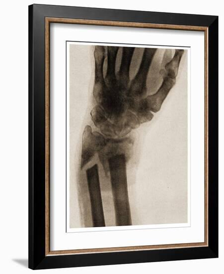 X Ray of a Fractured Wrist C.1890-German School-Framed Giclee Print