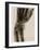 X Ray of a Fractured Wrist C.1890-German School-Framed Giclee Print