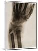 X Ray of a Fractured Wrist C.1890-German School-Mounted Giclee Print