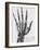 X-ray of a hand with buckshot-Science Source-Framed Giclee Print