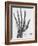 X-ray of a hand with buckshot-Science Source-Framed Giclee Print