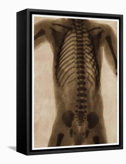 X Ray of a Human Torso C.1890-German School-Framed Premier Image Canvas